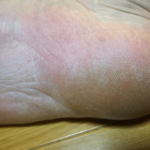 放置+病院での診察 水虫画像1-3