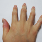 水虫I 水虫の疑い 病院には行っていない 水虫らしきものを指に発見