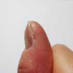 触るとデコボコしている。まずは市販薬を試してみたいと思っている。