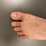 乾燥した指先の水虫(自己判断)