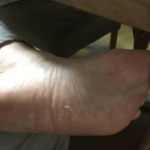 メンソレータムエクシブW液で水虫治療