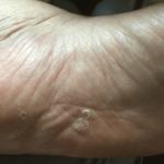 放置していて市販薬で治療開始