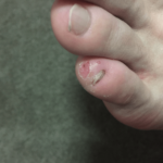 市販薬のラミシール軟膏で治療をしている