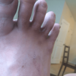 特に水虫の治療はしていない