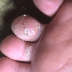 母親の水虫がうつった