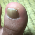 爪水虫にもなってしまった