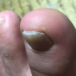 爪が厚くなってしまった爪水虫