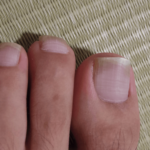 巻き爪で受診したら爪水虫と診断された