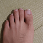 治療し始め6か月経過している爪水虫