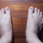 爪水虫と診断され2週間に1度通う状態