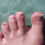 爪水虫のためラミシールの引用療法を行う