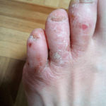 足の指に発生した水虫